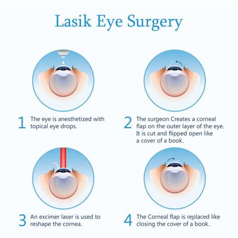 lasik eye surgery information